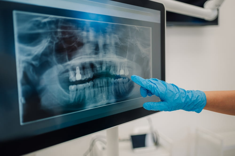 Dentist pointing at a dental x ray on a computer screen, highlighting details of teeth and jaw for effective diagnosis and treatment planning