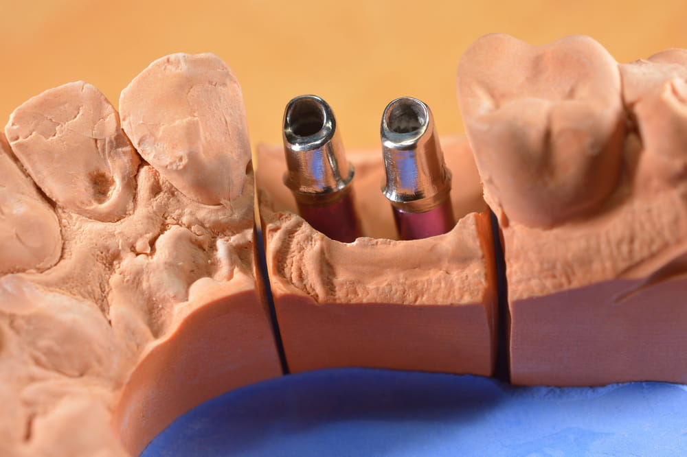 custom dental implants from above