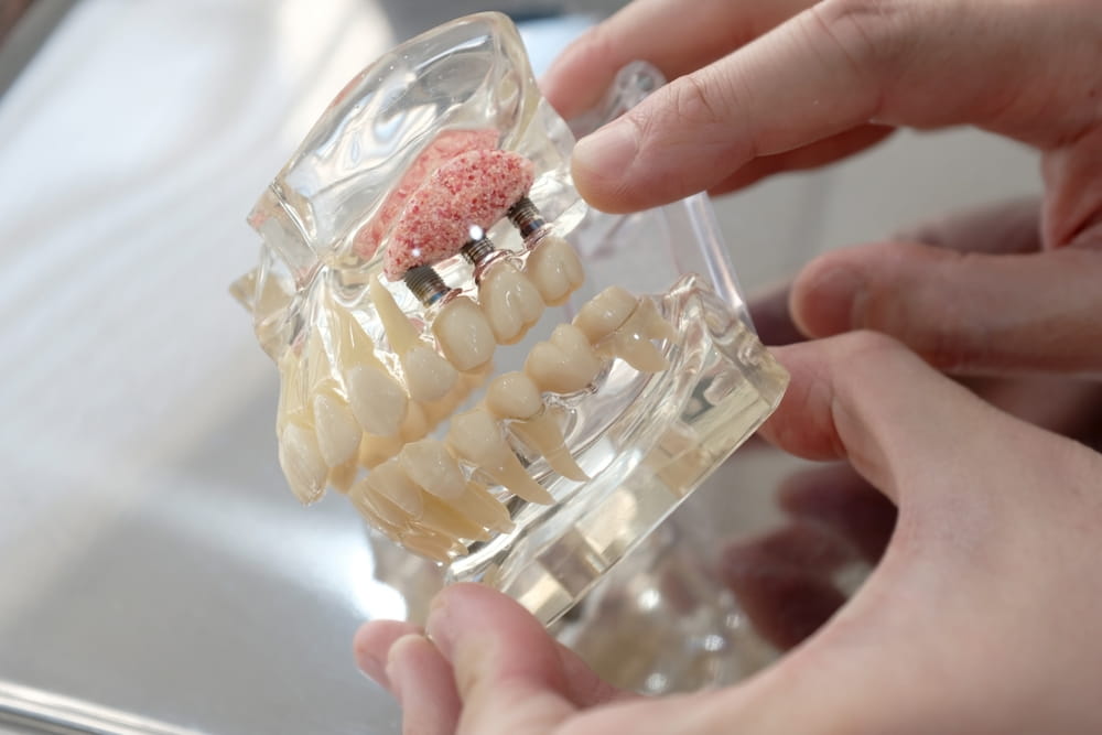 Dental tooth models, implants, maxillary sinus lift, bone grafting, educational and explanatory materials